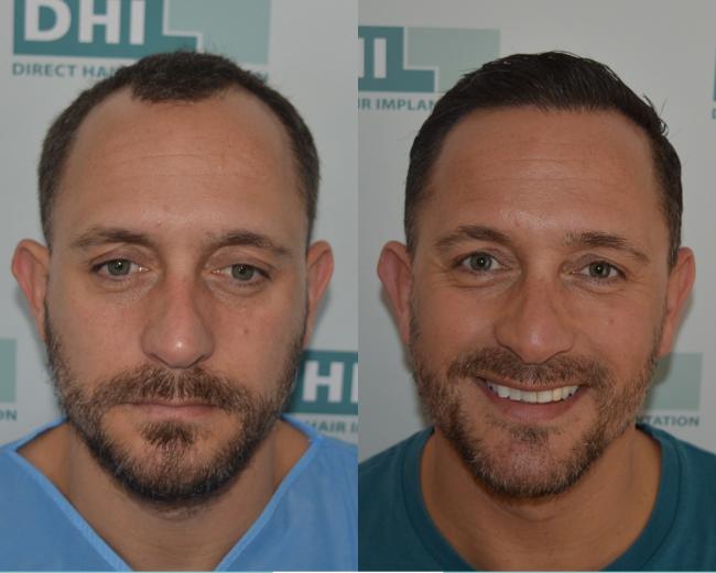 Scotland experiences huge demand for hair transplants amid pandemic |  Glasgow Times