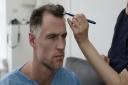 Above, Scotland rubgy star Tim Visser receives his hair transplant