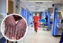 Number of monkeypox cases in Scotland rises to 40