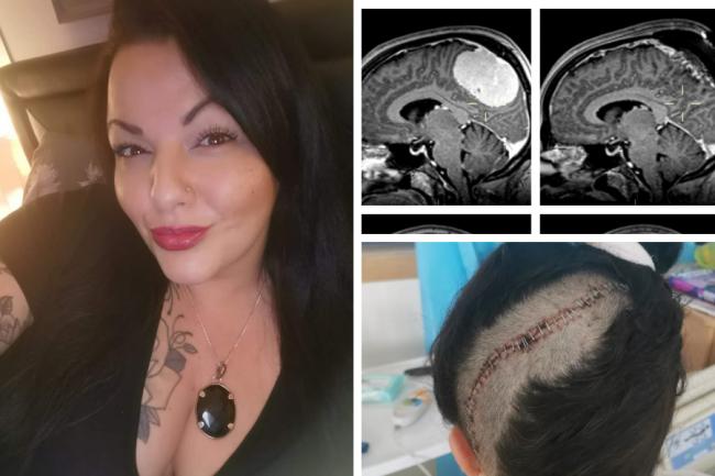 Woman battled migraines for 23 years before 4-inch tumour was found in her head urges others to get checked