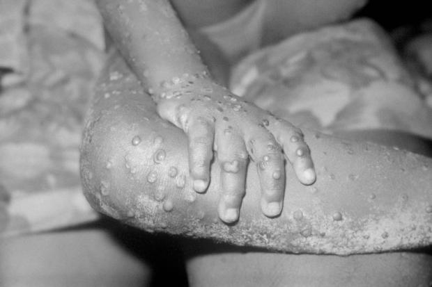 Glasgow Times: The monkeypox virus can be spread in a number of ways. Picture: PA