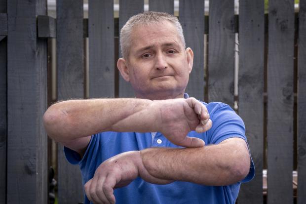 Man receives treatment in Glasgow after ‘world first’ double hand transplant