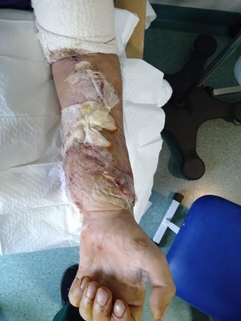 Glasgow Times: Picutred: Steven's hand after the operation