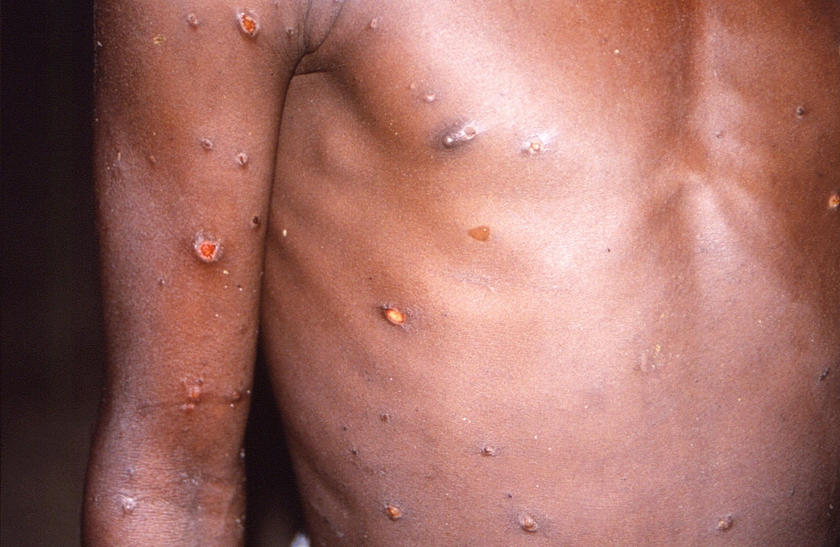 Number of UK Monkeypox cases starting to plateau, figures suggest