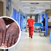 Number of monkeypox cases in Scotland rises to 40