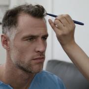 Above, Scotland rubgy star Tim Visser receives his hair transplant